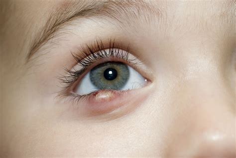 Stye Symptoms And Treatment In Children