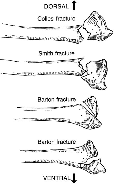 Colles Fracture Classification