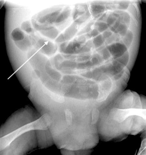 Necrotizing Enterocolitis X Ray