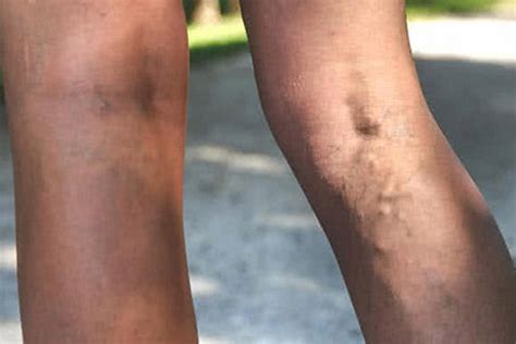 Things To Know About Varicose Veins And Spider Veins Endovascular Clinic