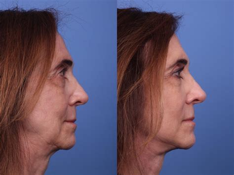 Facelift Before And After Pictures Case 302 Scottsdale Az Hobgood Facial Plastic Surgery