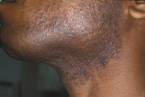 Razor Bumps Causes Prevention And Learn How To Get Rid Of Razor Bumps
