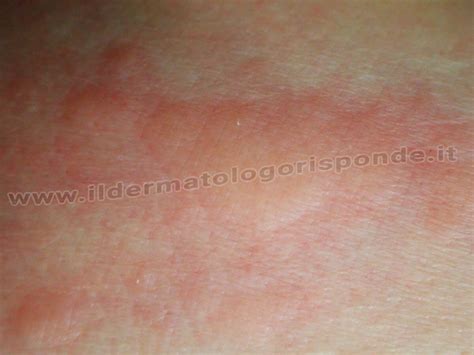 Orticaria solare di Borsch: rossore e prurito al sole