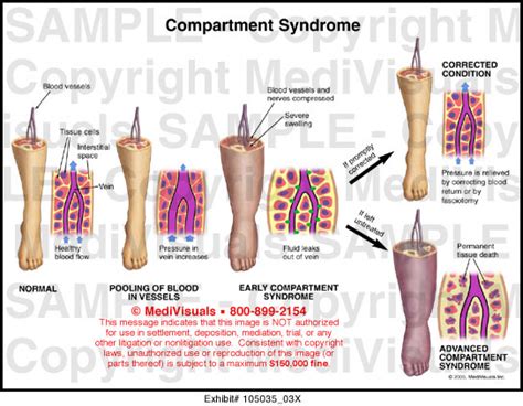 Compartment Syndrome Medical Illustration Medivisuals