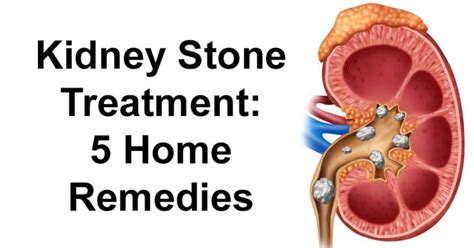 Kidney Stone Treatment 5 Home Remedies David Avocado Wolfe