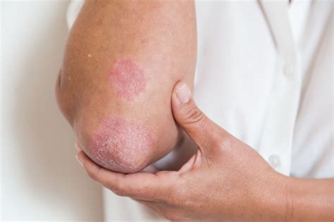 Psoriatic Arthritis Rash Symptoms And Treatment