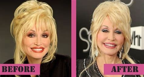 Dolly Parton Before And After Plastic Surgery 09 Celebrity Plastic