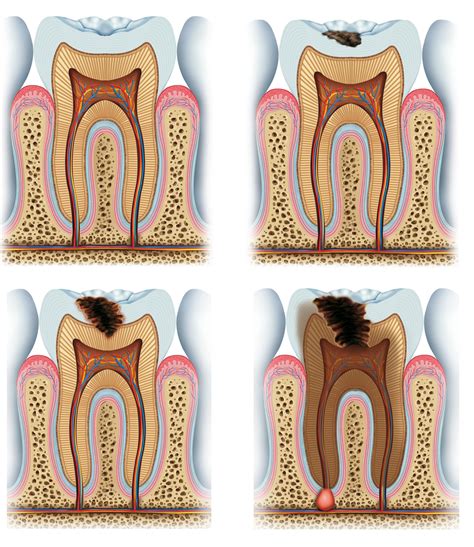Etapas De La Caries Estructura De La Anatom A Dental Incluyendo El