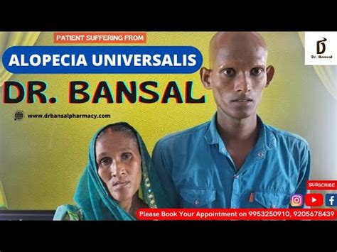 Patient Suffering From ALOPECIA UNIVERSALIS By Dr Bansal YouTube