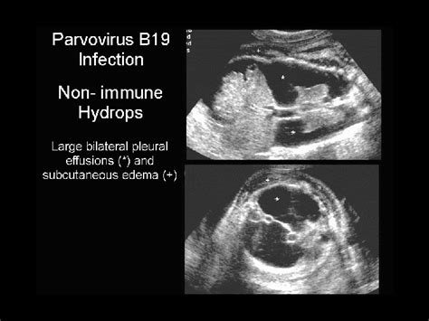 Congenital And Perinatal Infection Congenital Infections Presentation