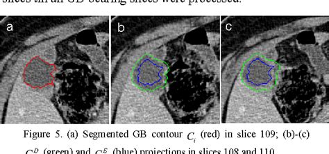 Figure 3 From Segmentation Of Gallbladder From Ct Images For A Surgical