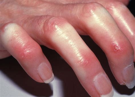Scleroderma Symptoms Pictures Causes Treatment Complications