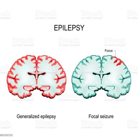 Epilepsy Primary Generalized Epilepsy And Focal Seizures Stock