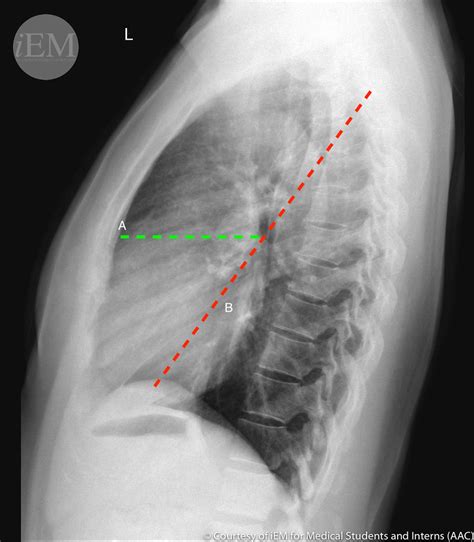 3376 Normal Lateral Chest X Ray Fissures 2 Minor A An Flickr