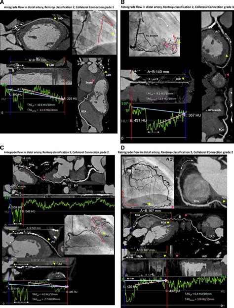 Noninvasive Evaluation Of Coronary Collateral Arterial Flow By Coronary