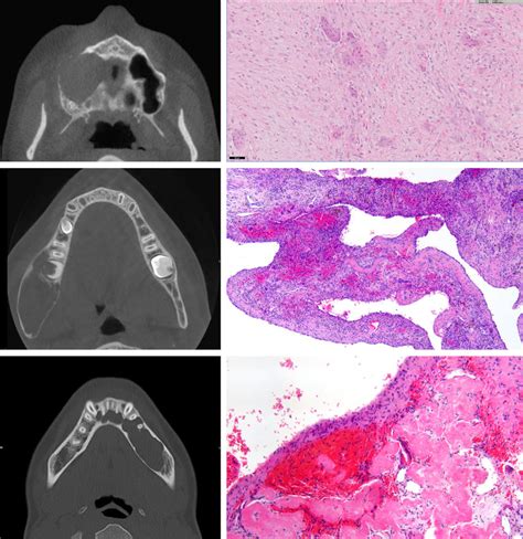 Radiology And Morphology Examples Of Giant Cell Lesions And Bone Cysts