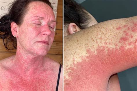 Mum Left In Agony With A Burning Rash Due To ‘severe Reaction To Covid