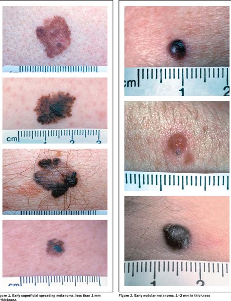 Table 1 From Nodular Melanoma No Longer As Simple As Abc Semantic