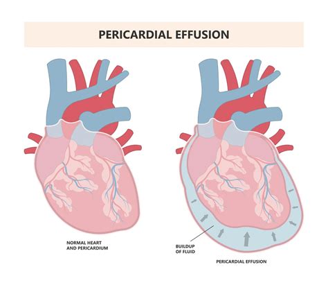 Blog Pericardial Effusion And Cardiac Tamponade Cardiologymaster