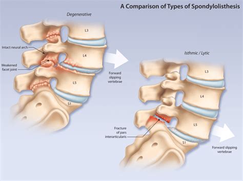 Spondylolisthesis All You Need To Know Dr Hepler