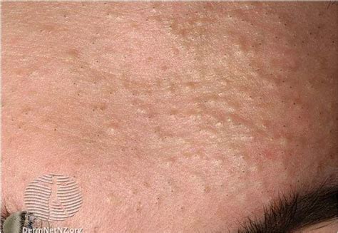 Comedo And Acne Pseudocyst Ailesbury Clinic