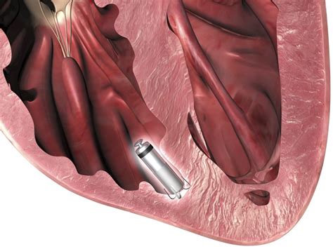 Leadless Pacemakers Associated With Fewer Complications The