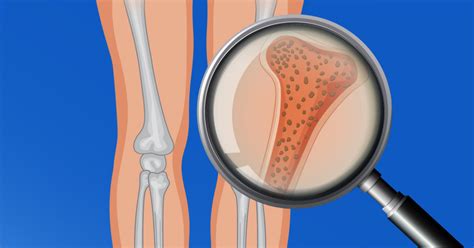 Los 5 tipos de Osteoporosis causas síntomas y tratamiento
