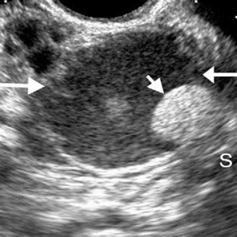 Ovarian Cyst Histology