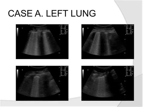 The Basics Of Lung Ultrasound