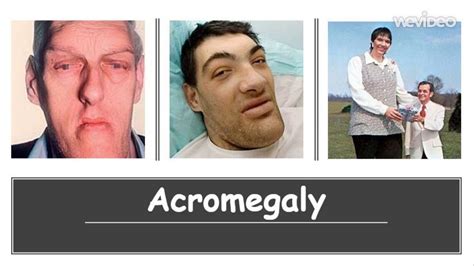 Acromegaly Causes Diagnosis Symptoms Treatment Prognosis Youtube