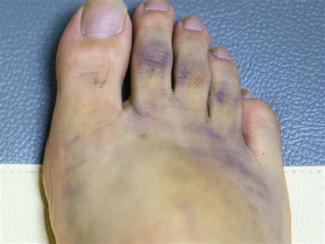 Diabetic Foot Ulcer Home Treatment Tribunsantri