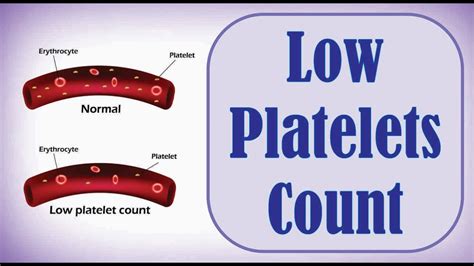 Low Platelets Count Youtube