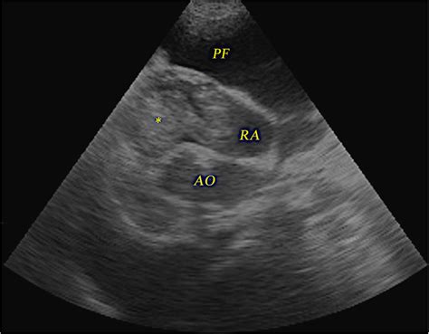 Echocardiography Of A Dog With Intracardiac Mass Right Parasternal