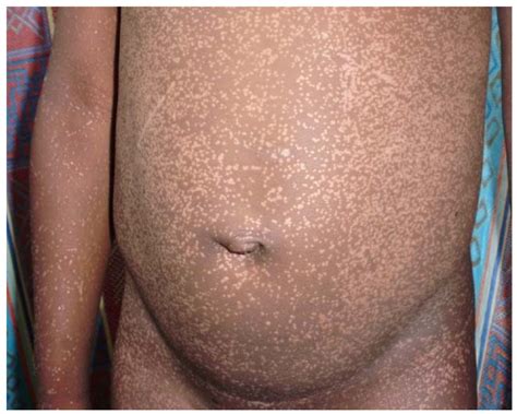 The Spectrum Of Skin Diseases In A Rural Setting In Cameroon Sub