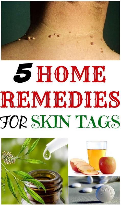 5 home remedies for skin tags daily beauty tricks dicas saúde cuidados com a pele