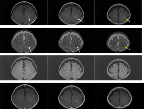 Focal Cortical Dysplasia Radiology Cases