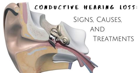 Conductive Hearing Loss Causes And Treatments Beverly Hills Hearing