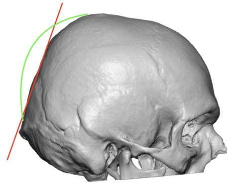 Plastic Surgery Case Study Back Of Head Reshaping With Occipital Knob