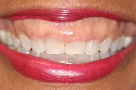 Accelerated Orthodontics Straighten Your Teeth In A Few Months Avon Dental Round Lake Beach