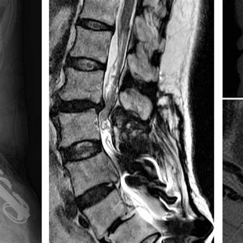 Lumbar Spine Anteroposterior A And Lateral B Radiographs Taken At