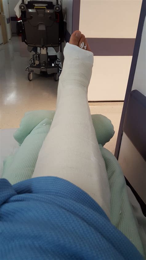 The Day I Broke My Leg Broken Tibia And Fibula With Intramedullary Nail