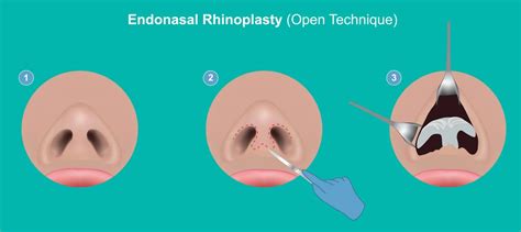 Rhinoplasty Singapore Nose Surgery Singapore Tes Clinic For Face