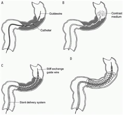 Colorectal Stent Placement Radiology Key