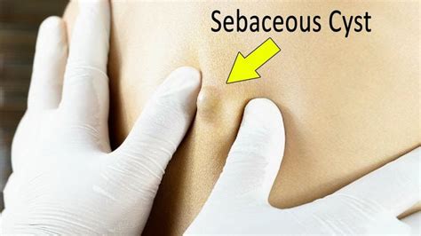 A Comprehensive Guide To Natural Remedies For Sebaceous Cysts Herbal
