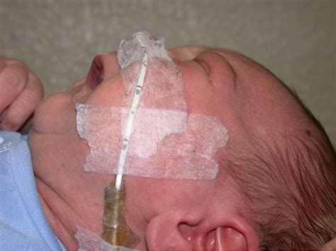 Pierre Robin Baby Supine With Feeding Tube Earwell Center Of Excellence