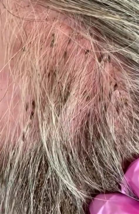 The Lice Angels Experts Reveal Woman With ‘worst Case Of Head Lice Photo Herald Sun