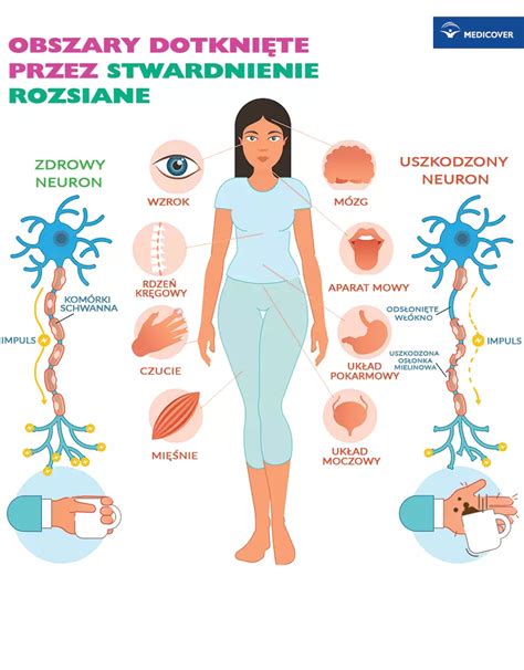 Stwardnienie Rozsiane Objawy I Leczenie Stwardnienia Rozsianego