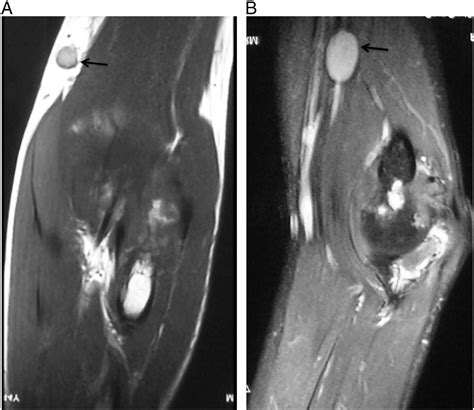 Magnetic Resonance Imaging Findings In Tubercular Arthritis Of Elbow