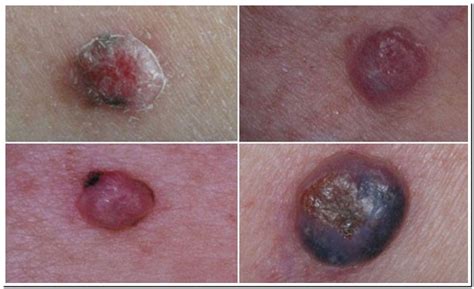 Difference Between Nodular Melanoma And Blood Blister Best Reviews
