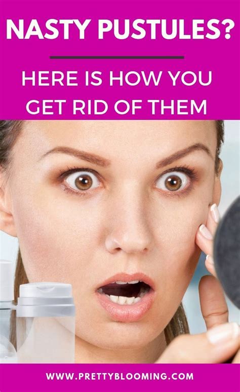 What Are Pustules How To Treat Them Pustules Acne Affordable Skin